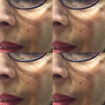 Detatouage Grain De Beaute La Seance